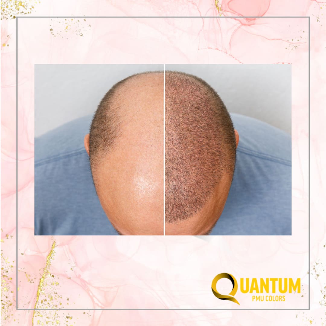 Cancer Patients Benefit from Scalp Micropigmentation Cancer Patients Benefit from Scalp Micropigmentation